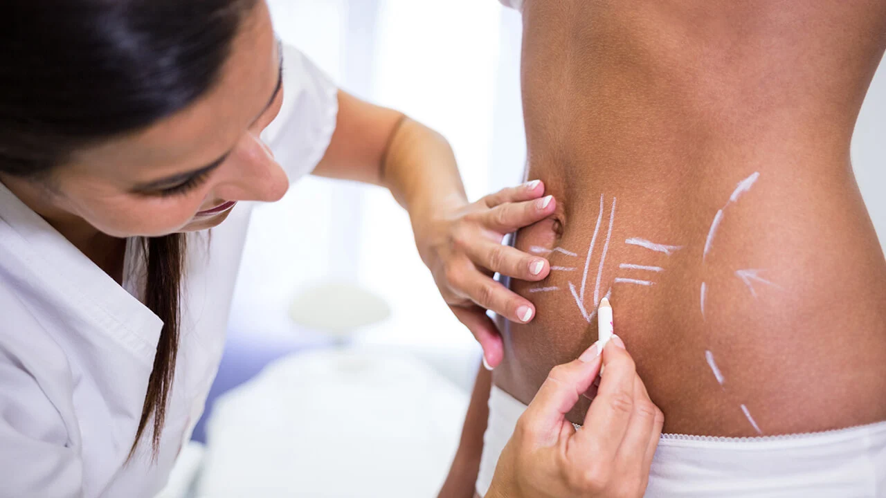 Liposuction