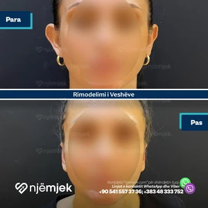 Para & Pas Rimodelimi i Veshëve
