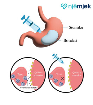 Botoksi Gastrik