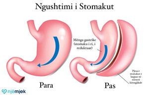 Çka duhet të dini para se të vendosni për Ngushtimin e Stomakut?