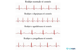Aritmia e zemrës