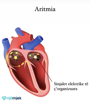 Aritmia e zemrës