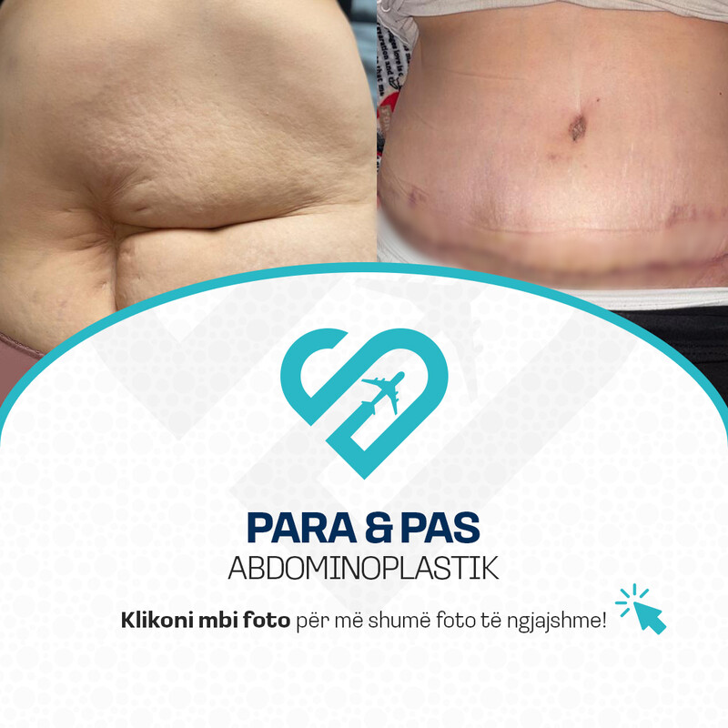 Para & Pas Abdominoplastik