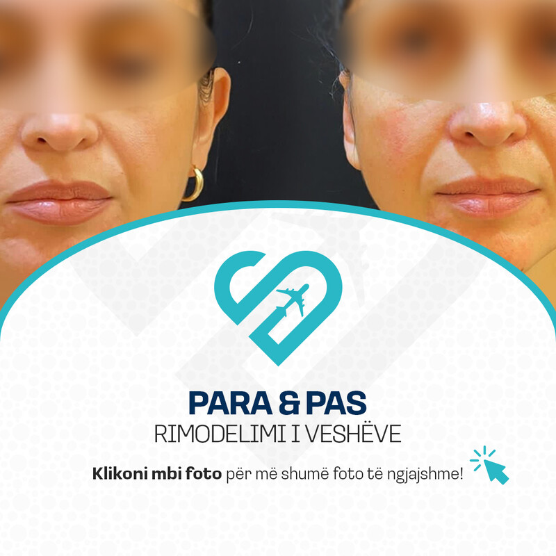 Para & Pas Rimodelimi i Veshëve