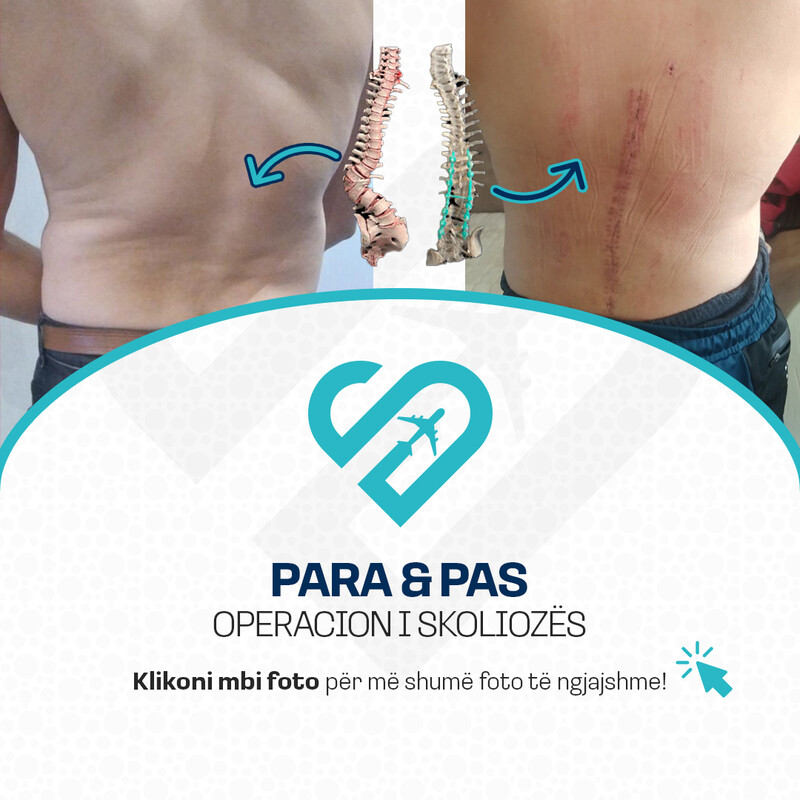Para & Pas Operacion i Skoliozës