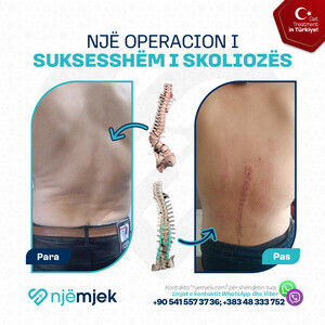 Para & Pas Operacion i Skoliozës