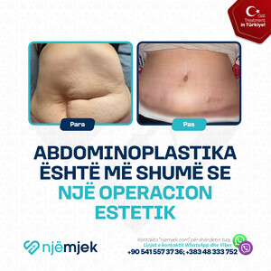 Para & Pas Abdominoplastik