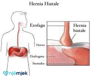 Hernia Hiatale - Shkaqet dhe Simptomat
