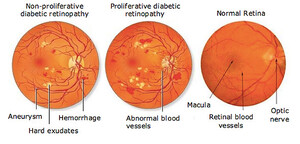 Efekti i diabetit në sy: Retinopatia Diabetike