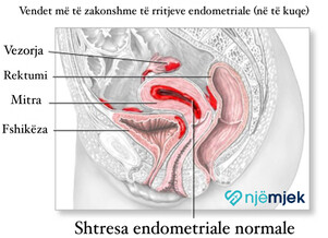 Endometrioza: Shkaqet, Simptomat, Diagnoza dhe Trajtimi