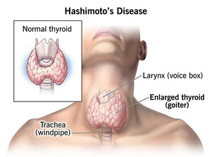 Hipotiroidizmi: Tiroidea joaktive