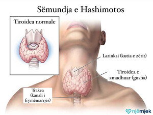 Hipotiroidizmi: Tiroidea joaktive