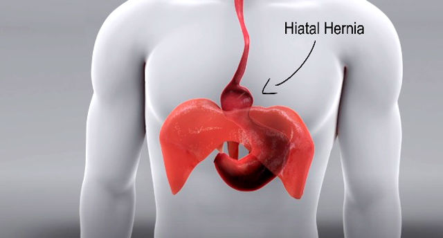 Hernia Hiatale - Shkaqet dhe Simptomat