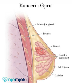 Gjithçka rreth Kancerit të Gjirit - Shkaqet, Diagnoza dhe Trajtimi