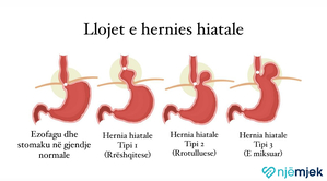 Hernia Hiatale - Shkaqet dhe Simptomat