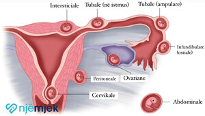 Shtatzënia Ektopike - Një Shtatzëni Jashtë Mitrës