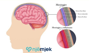 Meningjiti: Inflamacioni i Membranave të Trurit