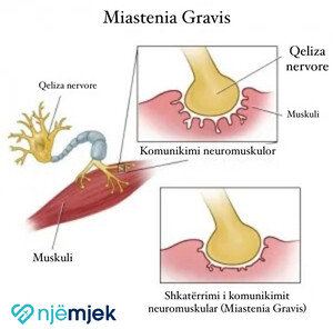 Miastenia Gravis - Nga Dobësia do të Vijë Forca