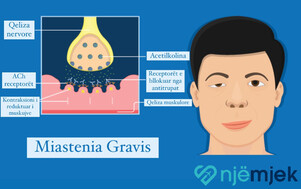 Miastenia Gravis - Nga Dobësia do të Vijë Forca