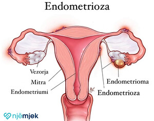 Endometrioza: Shkaqet, Simptomat, Diagnoza dhe Trajtimi