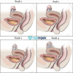 Endometrioza: Shkaqet, Simptomat, Diagnoza dhe Trajtimi