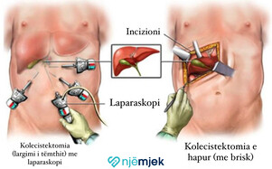 Gurët e Fshikëzës së Tëmthit (Kolelitiaza)