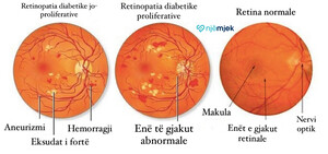 Efekti i diabetit në sy: Retinopatia Diabetike