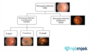 Efekti i diabetit në sy: Retinopatia Diabetike