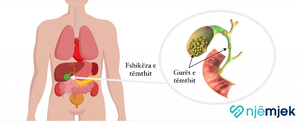 Gurët e Fshikëzës së Tëmthit (Kolelitiaza)