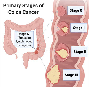 Kanceri i Kolonit: Simptomat, Fazat dhe Trajtimi