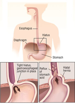Hernia Hiatale - Shkaqet dhe Simptomat