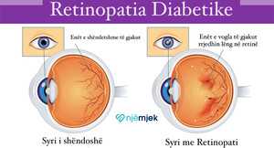 Efekti i diabetit në sy: Retinopatia Diabetike