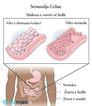 Sëmundja Celiac – Intoleranca ndaj Glutenit