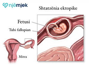 Shtatzënia Ektopike - Një Shtatzëni Jashtë Mitrës