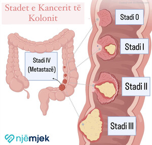 Kanceri i Kolonit: Simptomat, Fazat dhe Trajtimi