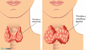 Hipotiroidizmi: Tiroidea joaktive