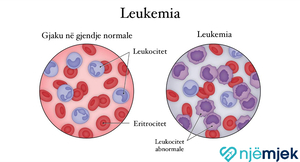 Leukemia (Kanceri i Gjakut)