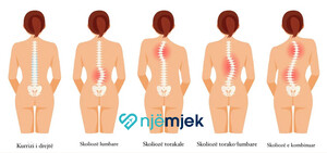 Skolioza - Simptomat, Diagnoza dhe Trajtimi