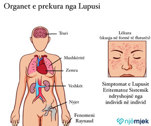 Sëmundja e Lupusit (Lupusi Eritematoz Sistemik)