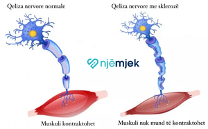 Skleroza e Shumëfishtë (MS): Shkaqet, Simptomat dhe Trajtimi