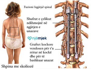 Skolioza - Simptomat, Diagnoza dhe Trajtimi