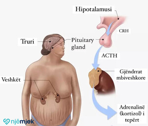 Sindroma Cushing | Hiperkortizolizmi