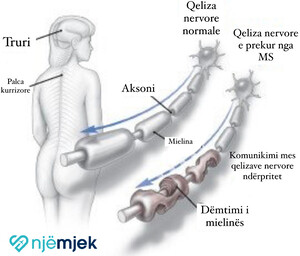 Skleroza e Shumëfishtë (MS): Shkaqet, Simptomat dhe Trajtimi