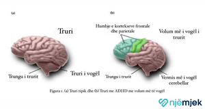 Çrregullimi i Mungesës së Vëmendjes/Hiperaktivitetit (ADHD)