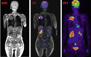 PET Scan - Tomografia e Emetimit të Pozitroneve