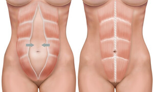 Rimodelimi i Barkut (Abdominoplastika)