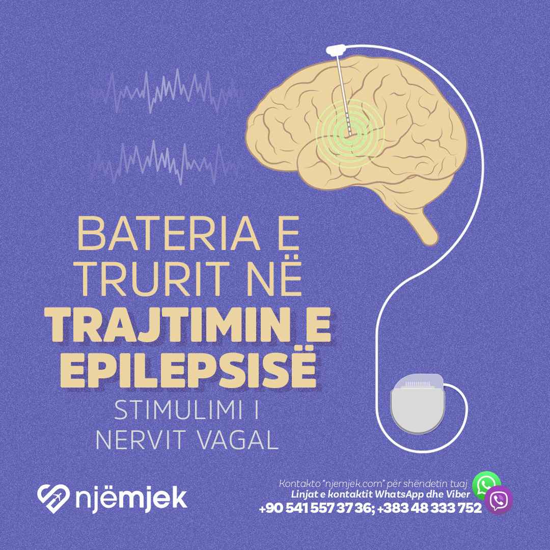 Trajtimi i Epilepsisë me Baterinë e Trurit