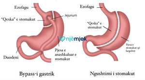 Ngushtimi i Stomakut vs Bypass-i i Stomakut