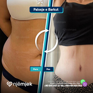 Para & Pas Abdominoplastik