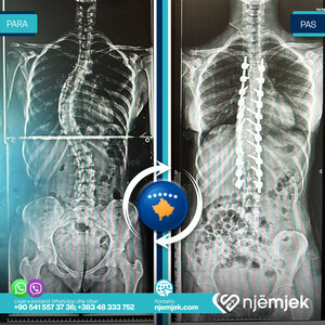 Para & Pas Operacion i Skoliozës